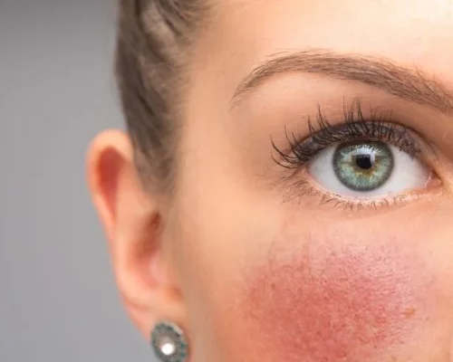 Jak wybrać idealny podkład do cery z trądzikiem różowatym?