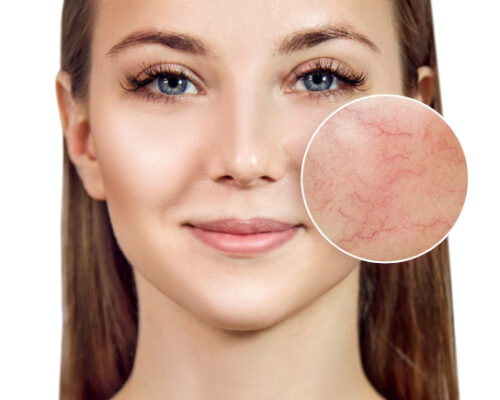 Cera naczynkowa pod lupą – poznaj jej potrzeby i najlepsze rozwiązania