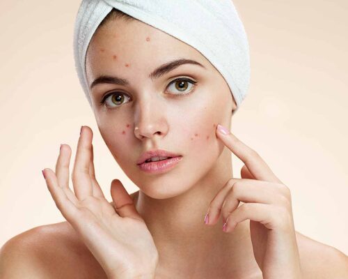 Cera trądzikowa – jak mądrze o nią dbać? 