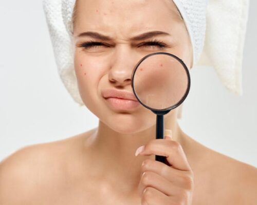 Domowe metody walki z trądzikiem – co naprawdę działa?