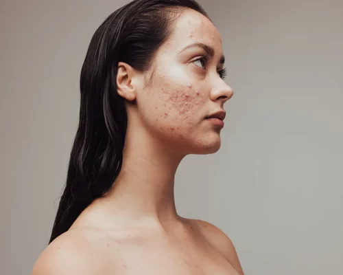 Domowe sposoby na trądzik