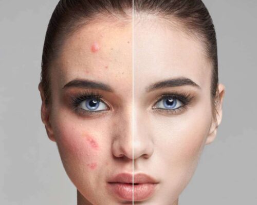 Jak pozbyć się trądziku? Domowe sposoby, które naprawdę działają