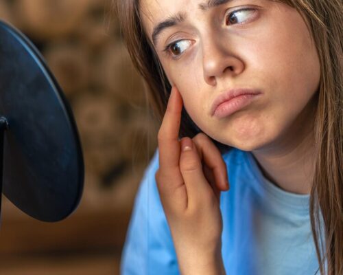 Jak się pozbyć pryszcza raz-dwa? Kompletny przewodnik z domową i kosmetyczną pomocą