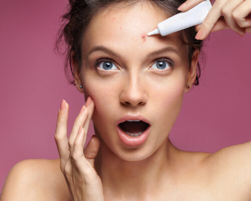Jakie kosmetyki na trądzik? Ranking hitów do cery problematycznej