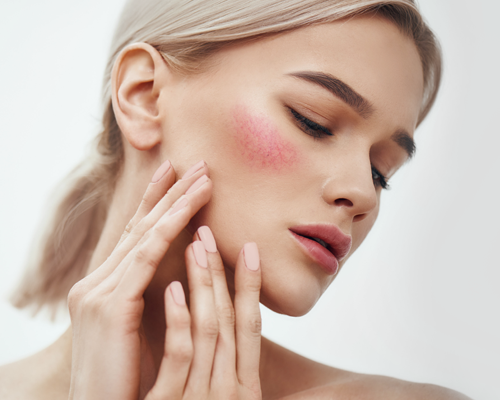 Pielęgnacja skóry z trądzikiem różowatym
