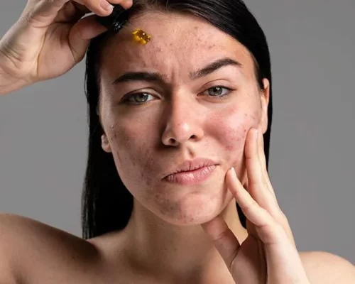 Sposoby na trądzik u dorosłych – jak pielęgnować cerę po 30. roku życia?