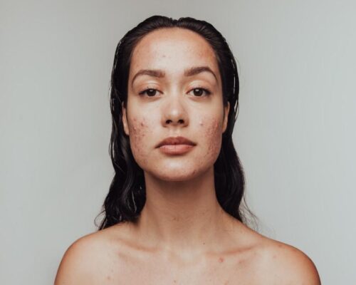 Trądzik dorosłych – jak skutecznie go leczyć?