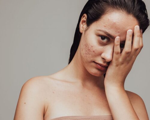Trądzik u dorosłych – skąd się bierze i jak skutecznie go leczyć?