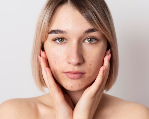 Trądzik – skąd się bierze i jak go skutecznie zwalczyć?