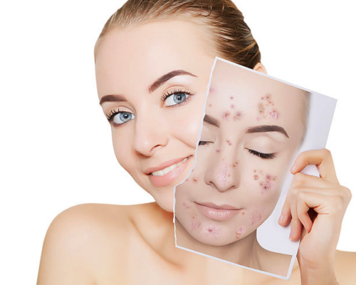 Pielęgnacja cery trądzikowej i tłustej. Kompleksowy plan pielęgnacji