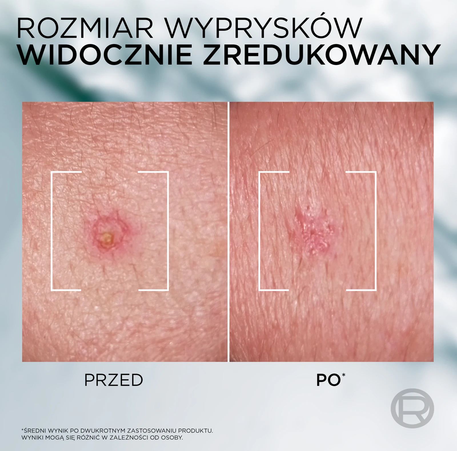 maseczka na niedoskonałości i zaskórniki